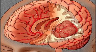 Giải đáp những vấn đề về bệnh u não