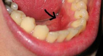 Vết loét có phải là dấu hiệu của ung thư khoang miệng không?
