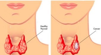 Một số phương pháp điều trị ung thư tuyến giáp phổ biến nhất hiện nay