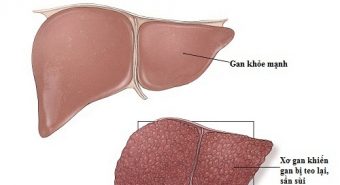 Những nguyên nhân gây xơ gan bạn có thể phòng tránh
