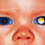 Những biểu hiện ung thư mắt ở trẻ cha mẹ cần nắm rõ