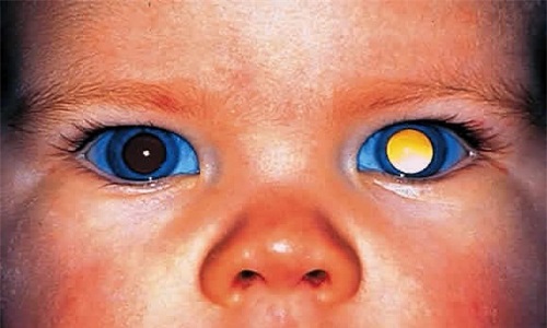 Mắt thay đổi màu sắc là biểu hiện ung thư mắt ở trẻ