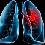 Những dấu hiệu cảnh báo ung thư phổi bạn đọc nên biết