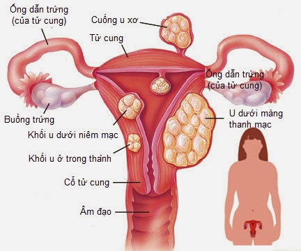 Những điều bạn cần biết về u xơ tử cung