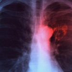 Những đối tượng có nguy cơ mắc ung thư phổi cao