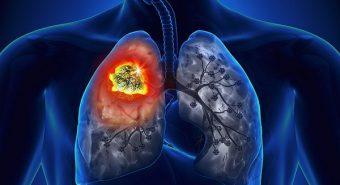 Thống kê những nguyên nhân hàng đầu gây ra bệnh ung thư phổi