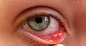 Những triệu chứng ung thư mắt cần nhận biết