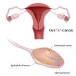 Phát hiện thêm nguyên nhân gây ung thư buồng trứng