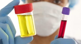 Phụ nữ cần cẩn thận với các triệu chứng bệnh ung thư bàng quang