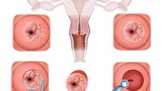 Phương pháp điều trị viêm lộ tuyến cổ tử cung phổ biến hiện nay