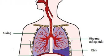 Tại sao bị tràn dịch màng phổi?