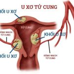 U xơ tử cung và những điều bạn cần phải biết