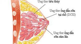 Tìm hiểu về ung thư biểu mô ống dẫn sữa tại chỗ