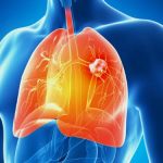 Ung thư phổi do ăn nhiều bột đường