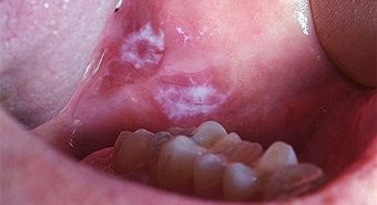 Ung thư miệng dễ nhầm lẫn với các bệnh về răng miệng thông thường