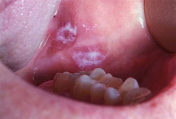 Dấu hiệu của ung thư miệng