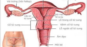 Viêm lộ tuyến cổ tử cung cản trở phụ nữ được làm mẹ