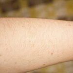 Báo động nốt ruồi trên cánh tay tỷ lệ thuận với nguy cơ ung thư da