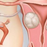 Đau bụng kéo dài - dấu hiệu của bệnh u xơ tử cung