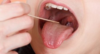 Bệnh ung thư lưỡi phát triển qua mấy giai đoạn?