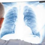 Sự nguy hiểm của căn bệnh ung thư phổi