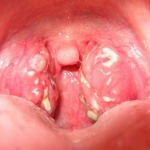 Bệnh viêm họng hạt có khó điều trị không?