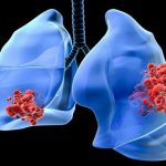 Cách đếm nhịp thở phát hiện bệnh viêm phổi