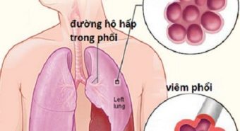 Những tác nhân gây bệnh viêm phổi khi vào viện