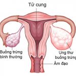 “Chân dài” dễ mắc bệnh ung thư buồng trứng