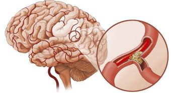 Cách dự phòng tai biến mạch máu não