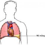 Vì sao bị bệnh tràn dịch màng phổi?