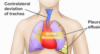 Cứu sống bệnh nhi bị tràn dịch màng phổi