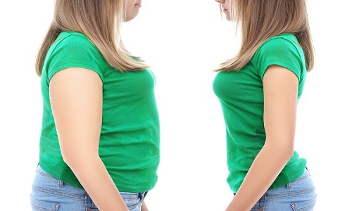 Thừa cân, béo phì làm tăng nguy cơ ung thư dạ dày