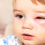 Cẩn thận tránh lầm tưởng viêm mắt với ung thư mắt ở trẻ