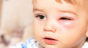 Cẩn thận tránh lầm tưởng viêm mắt với ung thư mắt ở trẻ