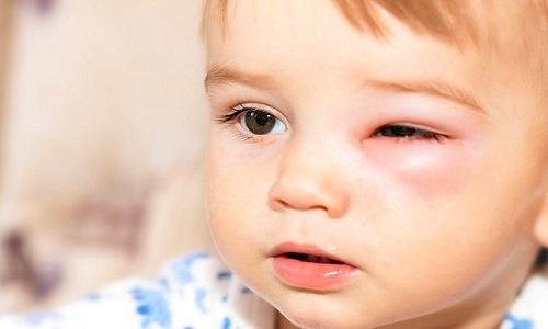 Lầm tưởng viêm mắt với ung thư mắt ở trẻ