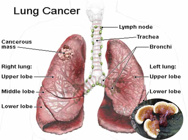 Nấm lim chữa bệnh ung thư phổi