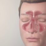 Viêm xoang mũi dị ứng: Cách nhận biết và điều trị dứt điểm