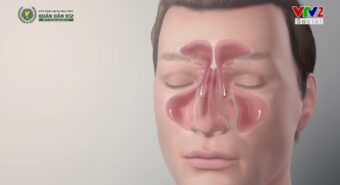 Viêm xoang mũi dị ứng: Cách nhận biết và điều trị dứt điểm